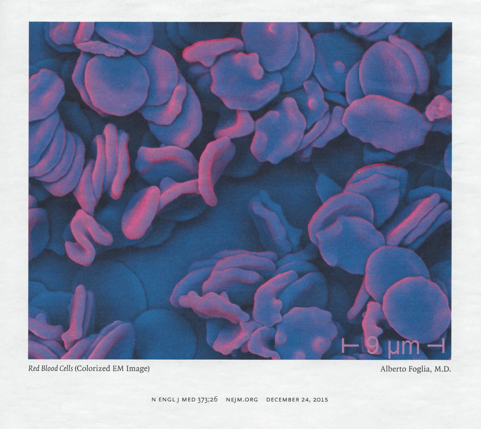 Red Blood Cells: immagine al microscopio elettronico colorizzata di Alberto Foglia, pubblicata nel New England Journal of Medicine